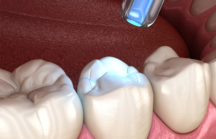 Trám Răng Bảo Vệ Nụ Cười Rạng Rỡ