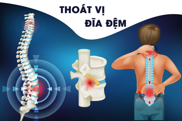 Bị Thoát Vị Đĩa Đệm Có Nên Đi Bộ Không?