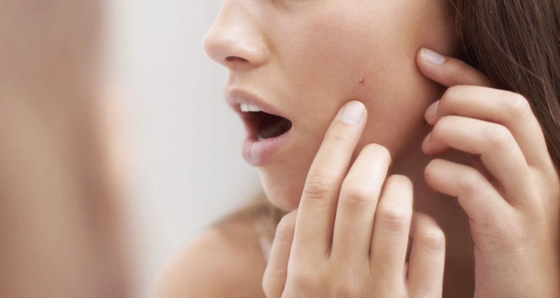 Tuổi Dậy Thì  Spa Nặn Mụn - Nên Hay Không Nên?